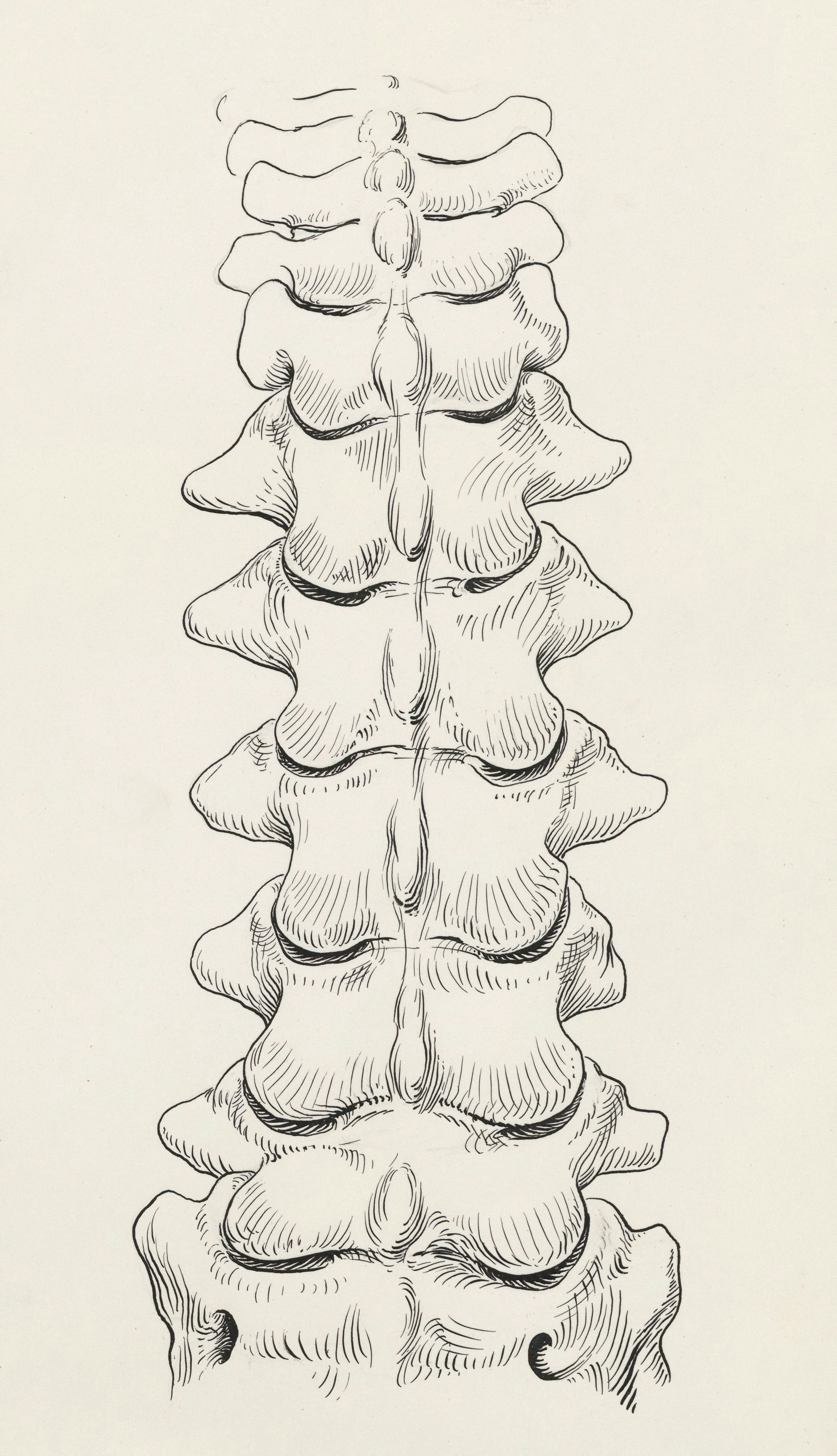 სქოლიოზის თერაპია